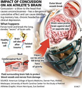 concussion-illustration